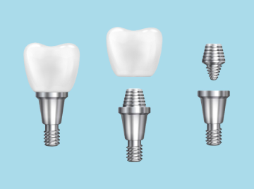 How to Care for Your Dental Implants and Ensure Longevity