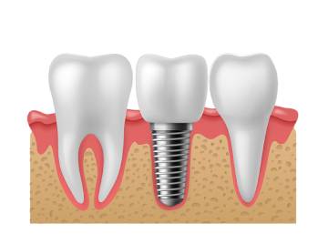 The Step-by-Step Process of Getting Dental Implants